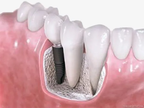 Implante Dental Fuengirola
